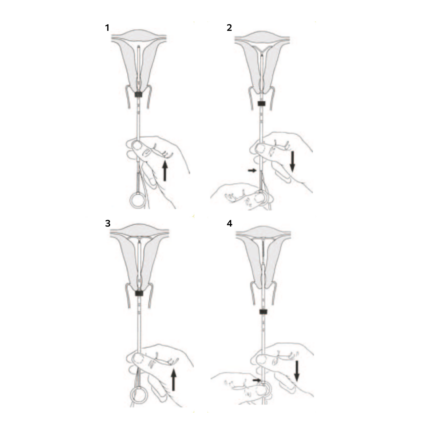 Spirale Anticoncezionale Intrauterina Sterile IUD a T CUT 380